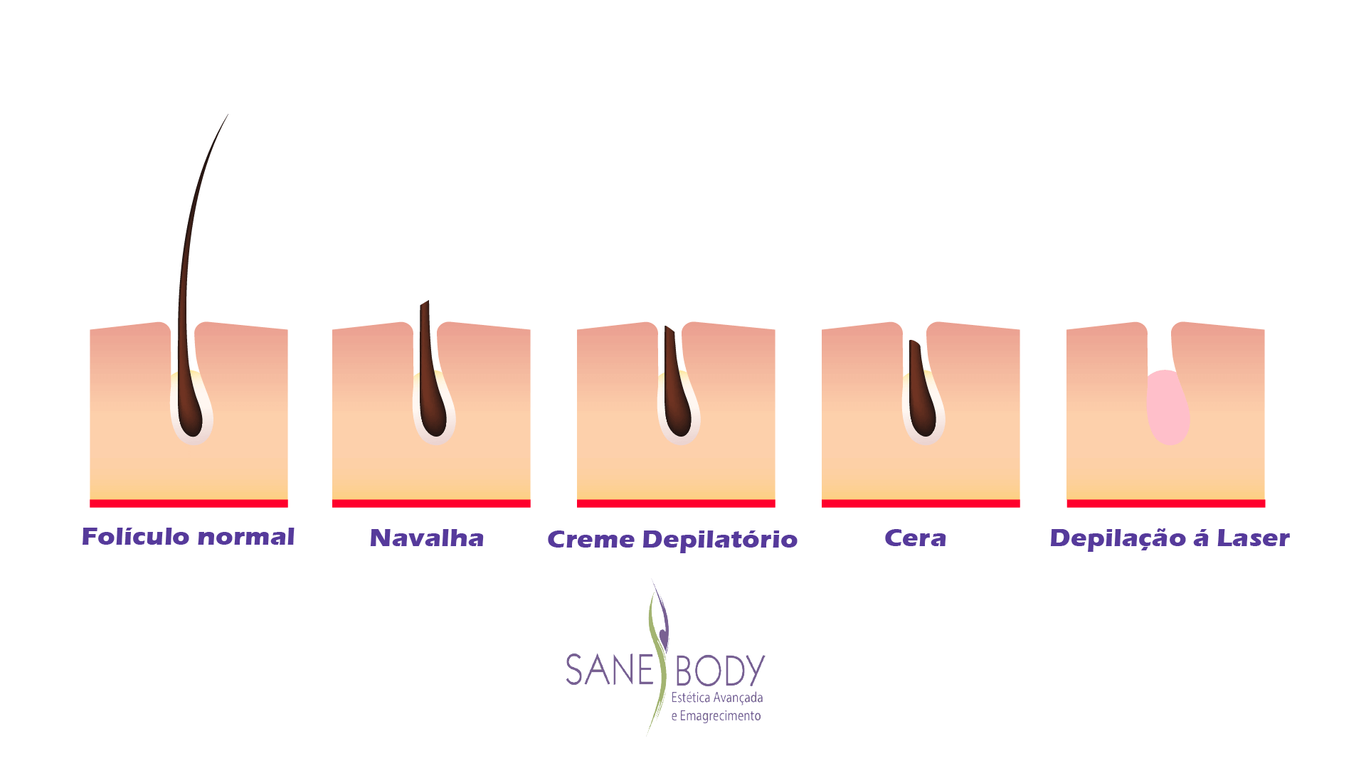 Depilação a Laser Sane Body Depilação a Laser Sane Body
